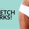 Everything you need to know about Stretch Marks! How Does Bellabaci Benefit you?