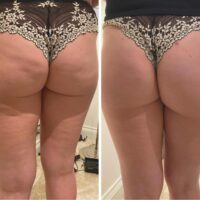 Cellulite Before and after1